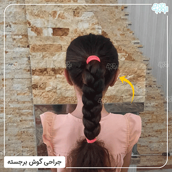 عکس بعد از عمل گوش برجسته کودکان از نمای پشت سر