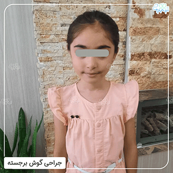 عکس بعد از عمل اتوپلاستی کودکان