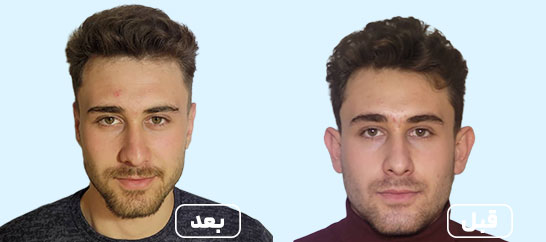 before after otoplasty