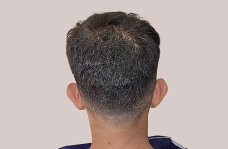 اتوپلاستی در الو جراح توسط دکتر مرادیان