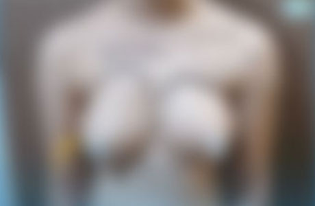 تخلیه سینه ترنس دکتر مرادیان