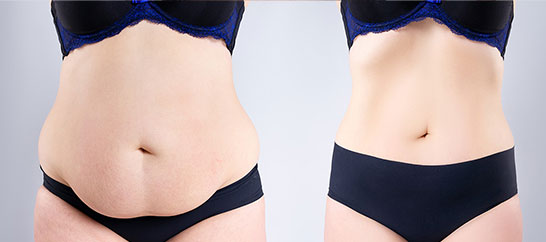 عمل ابدومینوپلاستی الو جراح 1