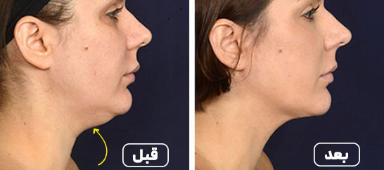 عمل غبغب در مجموعه جراحی زیبایی الوجراح