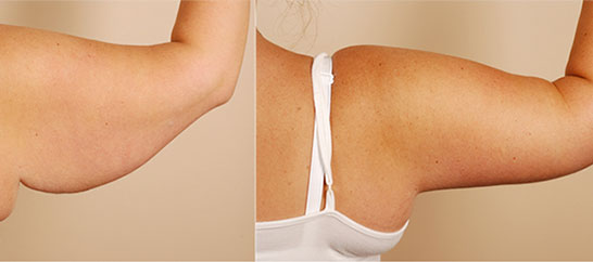 عمل لیفت بازو 1