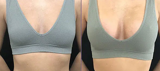 عمل پروتز سینه در الوجراح