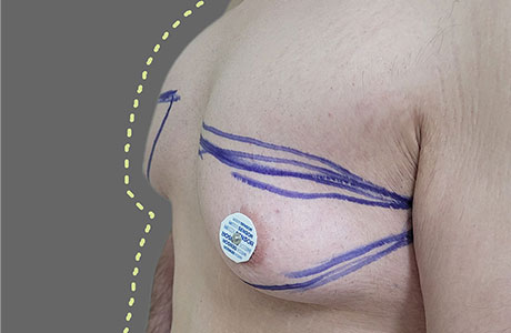 عمل ژنیکوماستی دکتر مرادیان در الو جراح