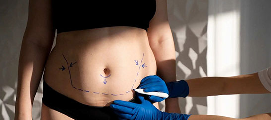 قبل از عمل لیپوماتیک شکم