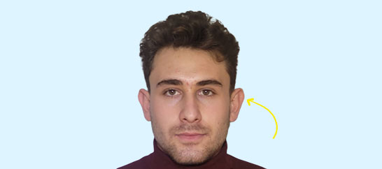 قبل عمل اتوپلاستی 1