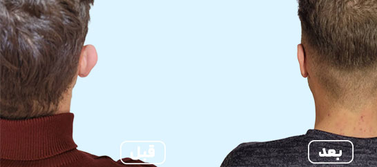 قبل و بعد اتوپلاستی 1-2