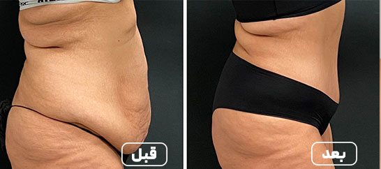 لیپوساکشن شکم 1