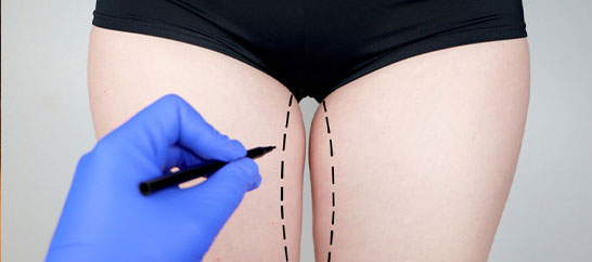 لیپوماتیک ران