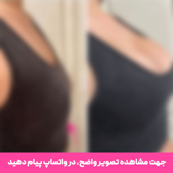 نمونه جراحی عمل پروتز سینه