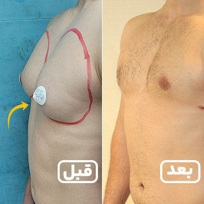 عمل جراحی ژنیکوماستی در مجموعه الوجراح(سه رخ راست)