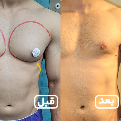 عمل جراحی ژنیکوماستی در مجموعه الوجراح(روبرو)