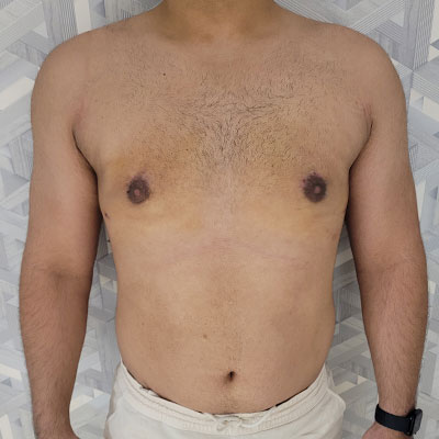 عکس بعد از عمل ژنیکوماستی شدید در الو جراح