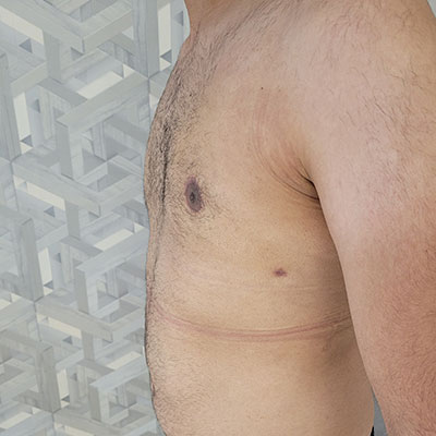 عکس بعد از جراحی ژنیکوماستی در مرکز جراحی الو جراح یک ماه بعد از عمل