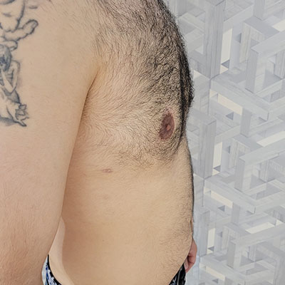 عکس جراحی سینه مرد در الو جراح