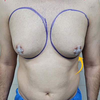 عکس قبل از جراحی سینه مرد در الو جراح از نمای رو به رو