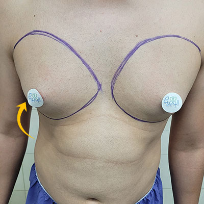 عکس قبل از جراحی ژنیکوماستی در مرکز جراحی الو جراح