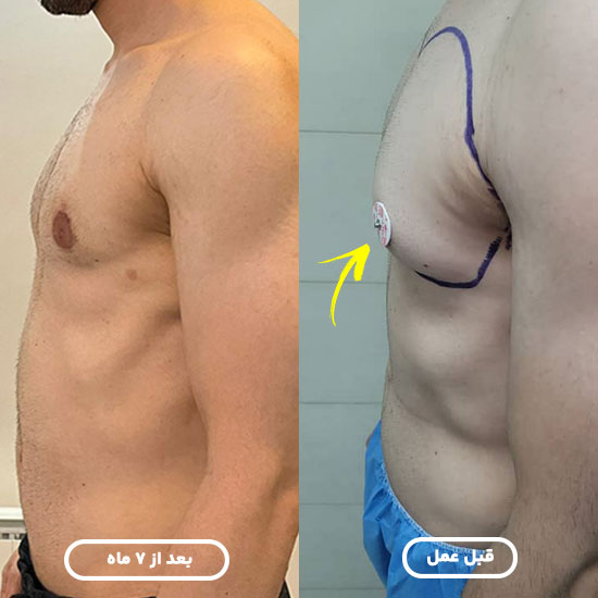 هزینه عمل ژنیکوماستی الو جراح