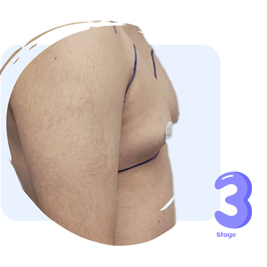 ژنیکوماستی استیج 3