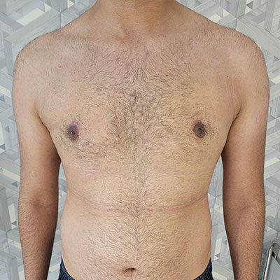 عکس بعد از جراحی سینه مرد در الو جراح از نمای رو به رو تانر 3