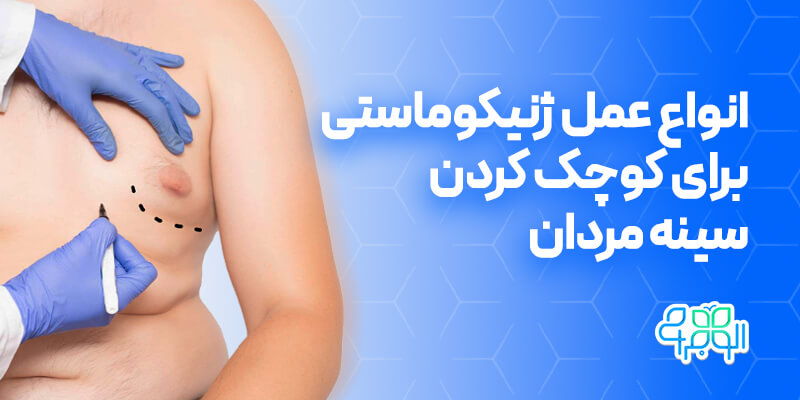 انواع عمل ژنیکوماستی