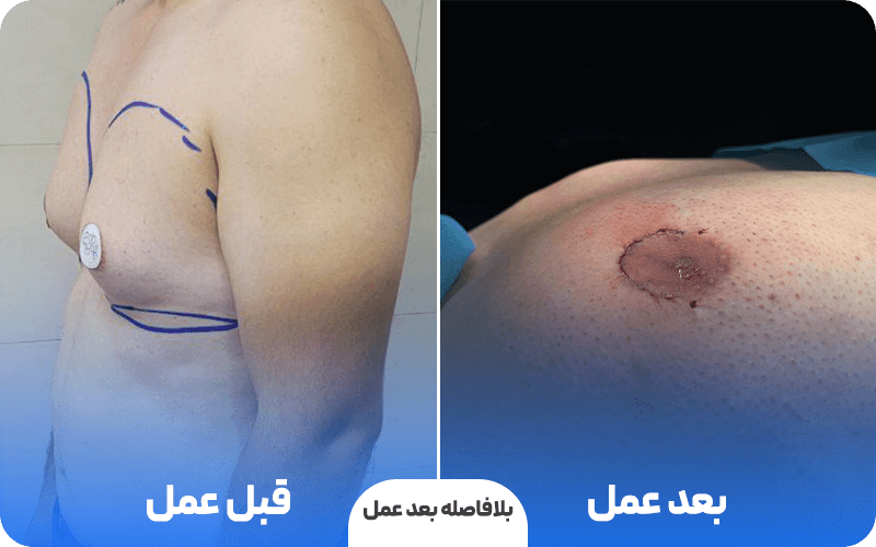 محل بخیه ژنیکوماستی