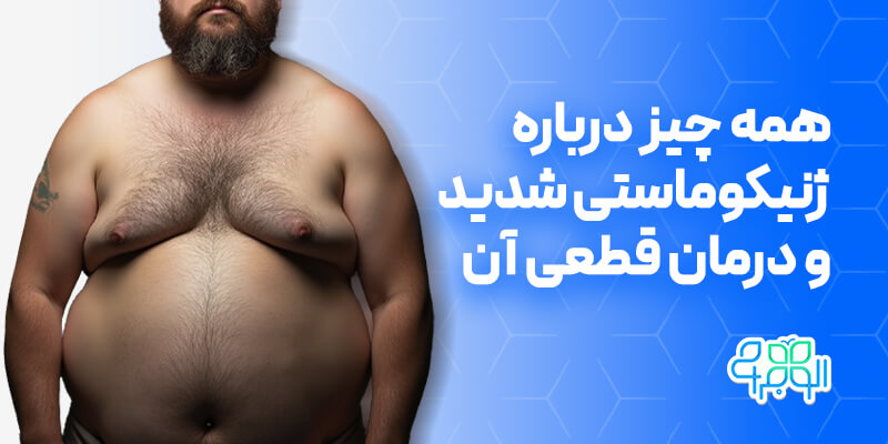 ژنیکوماستی شدید