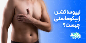 لیپوساکشن ژنیکوماستی